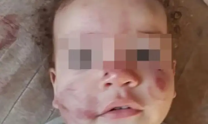 Mãe faz denúncia após bebê voltar de creche com rosto machucado em Bom Despacho