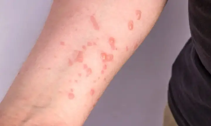 OMS declara emergência de saúde pública devido à mpox