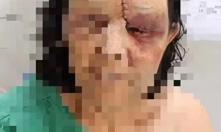 Sogra fica com rosto desfigurado ao defender a filha agredida por marido embriagado em Luz MG