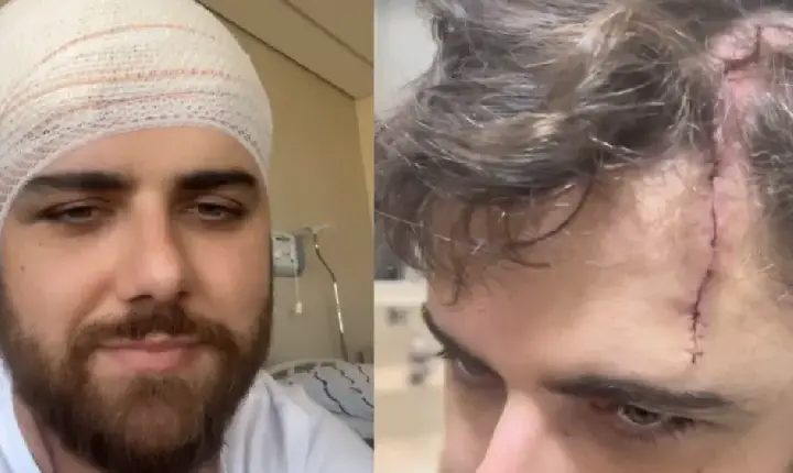 Zé Neto impressiona ao mostrar cicatriz gigante na cabeça após acidente; veja