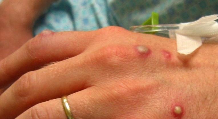 Governo confirma o primeiro caso de varíola do macaco em MG