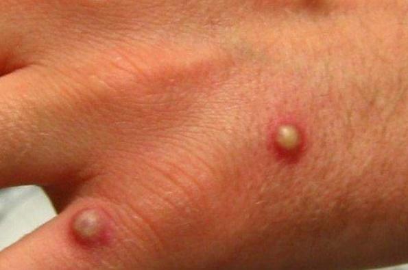 Araxá confirma primeiro caso de Varíola do Macaco