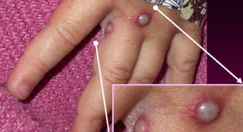 Brasil tem dois casos de varíola do macaco em bebês com menos de um ano