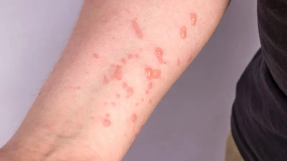 OMS declara emergência de saúde pública devido à mpox