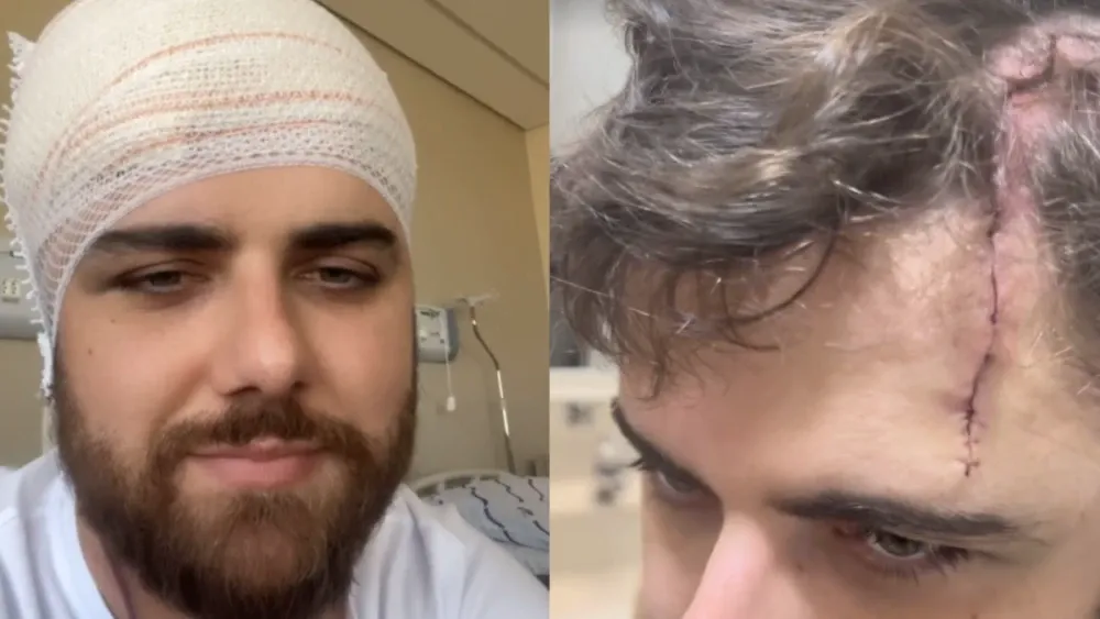 Zé Neto impressiona ao mostrar cicatriz gigante na cabeça após acidente; veja
