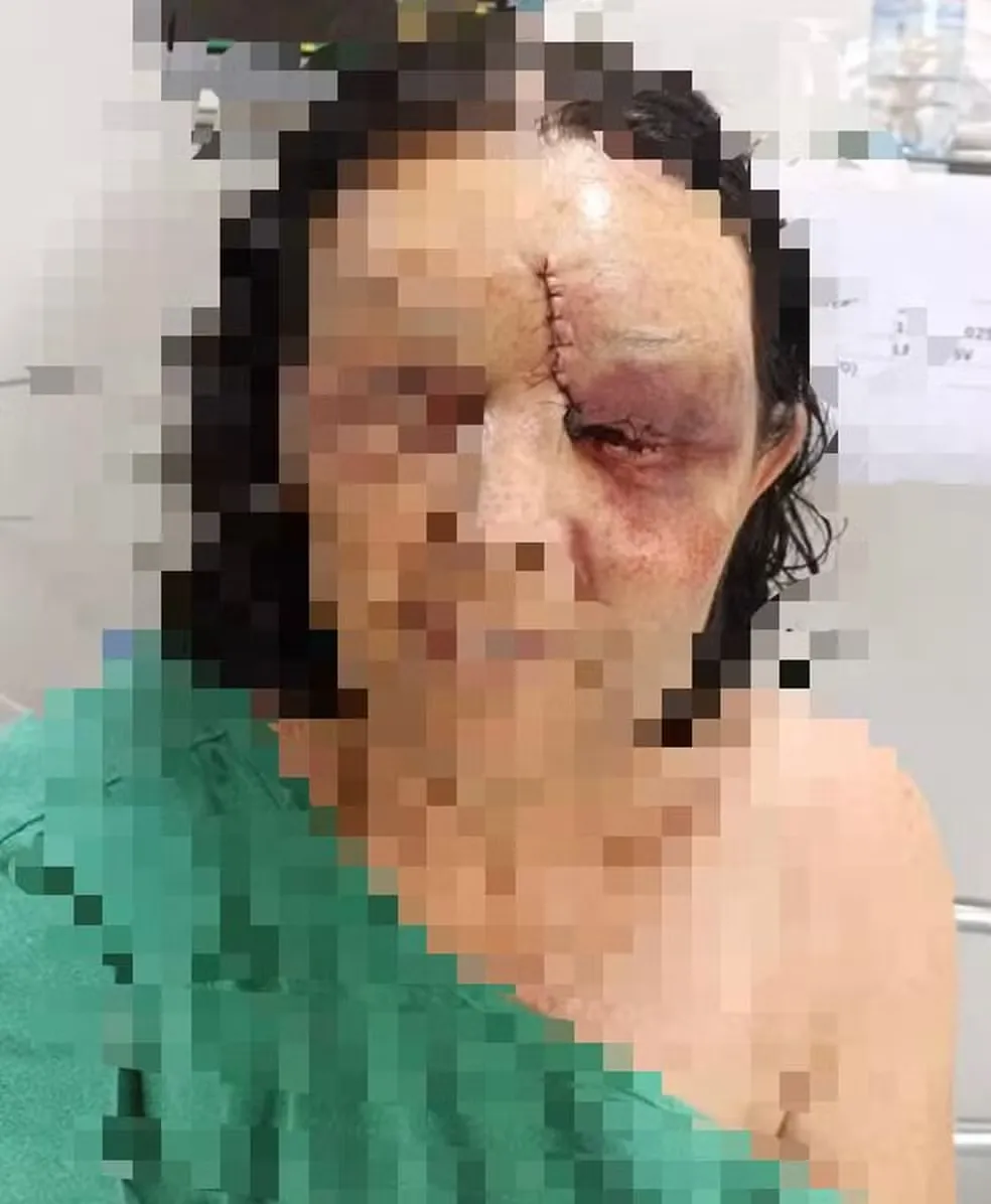 Sogra fica com rosto desfigurado ao defender a filha agredida por marido embriagado em Luz MG